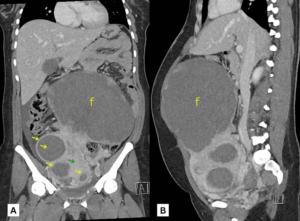 poze fibrom uterin 