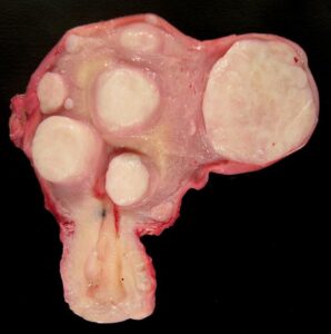 poze fibrom uterin 